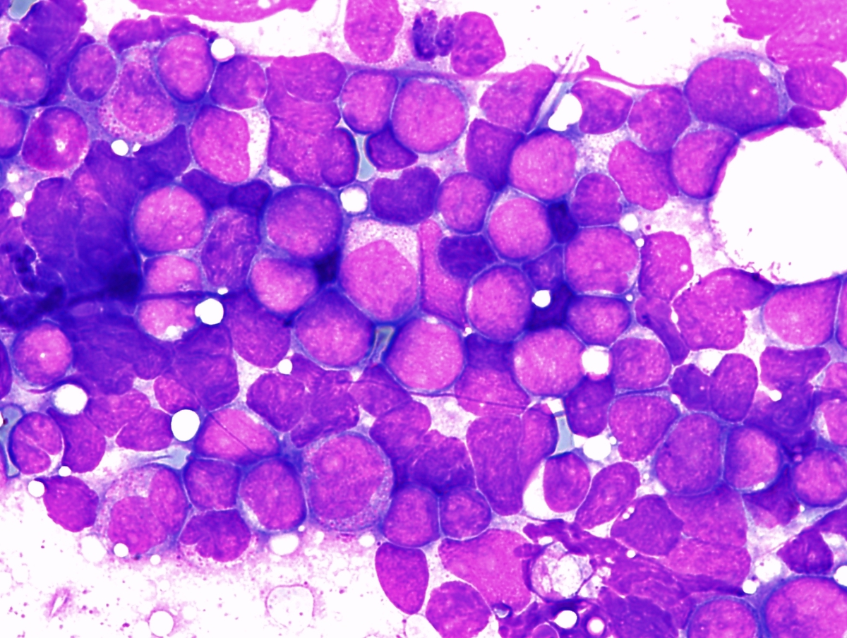 Intraoperative cytology, high power